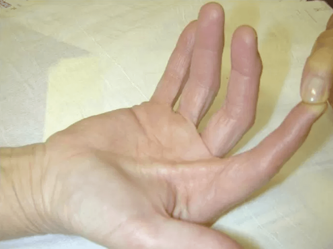 Injuries to the flexor tendon pulley system of the hand