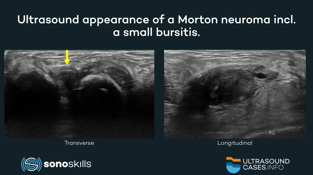 Morton’s neuroma: MRI or musculoskeletal ultrasound?