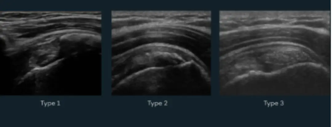Ultrasound-Guided Barbotage of a Calcification: An Approach to Tendon Health