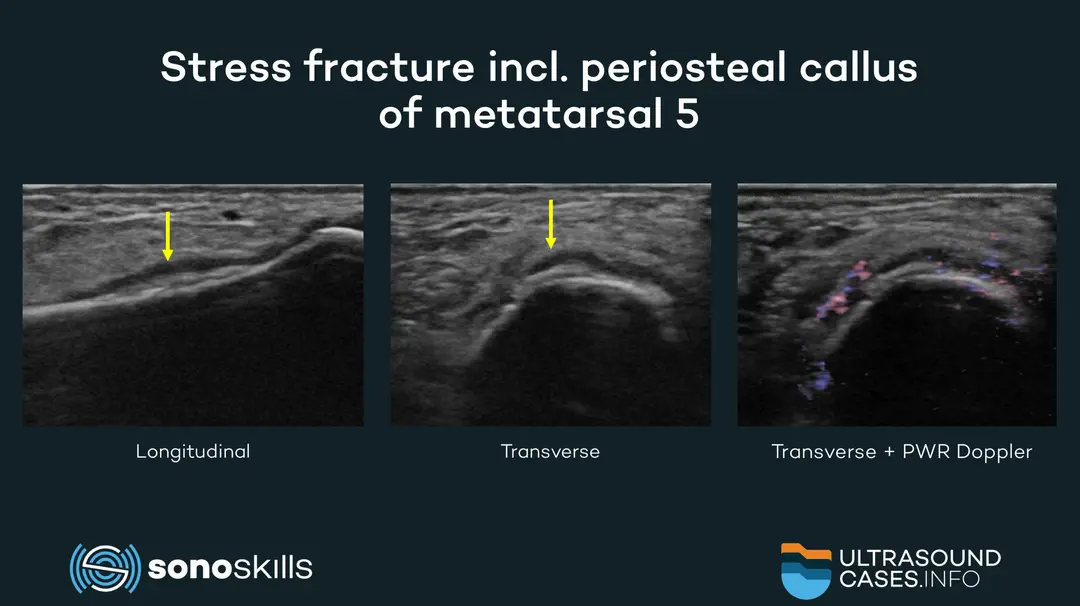 Using musculoskeletal ultrasound in the diagnosis of metatarsal fractures