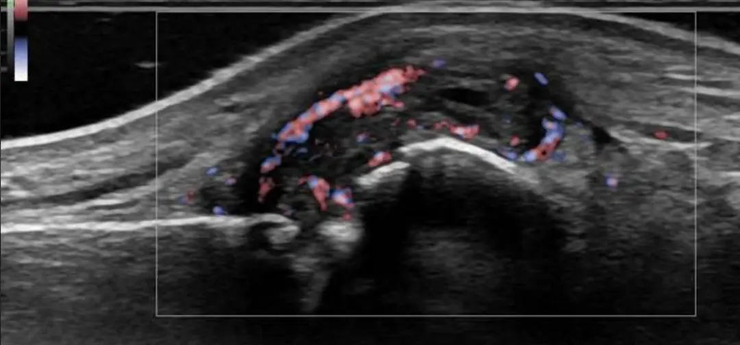 Musculoskeletal Ultrasound in the Diagnosis of Rheumatoid Arthritis