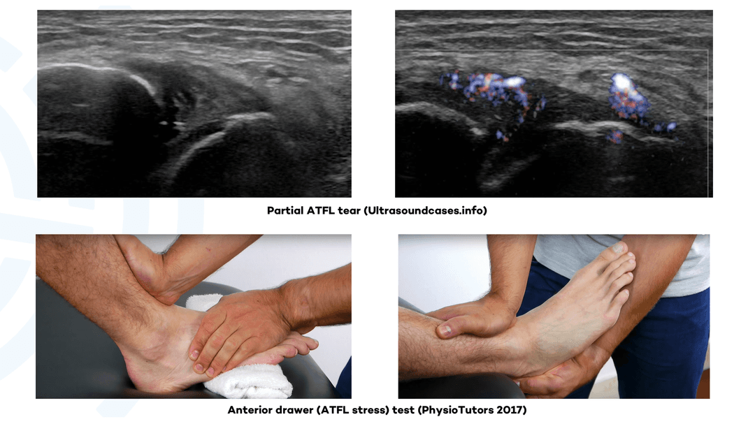 The anterior talofibular ligament ultrasound guided stress test