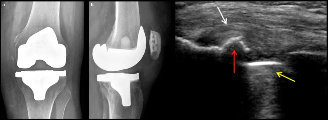 Snapping of the popliteal tendon after total knee arthroplasty