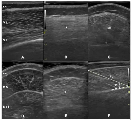 Musculoskeletal Ultrasound: A Guide to Assessing Muscular Dystrophy
