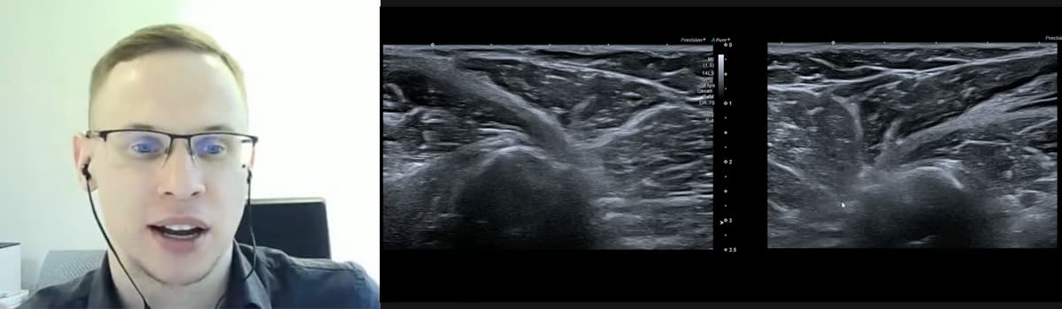 Point-of-Care Shoulder Ultrasound in Pain Practice