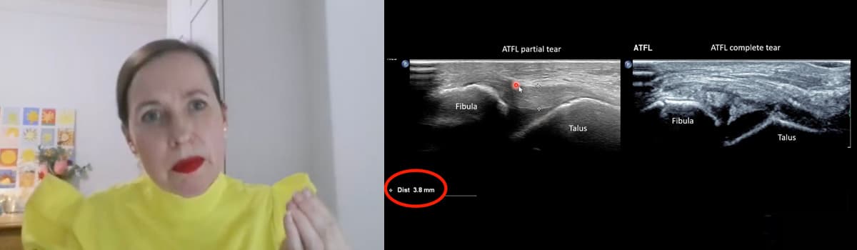 Ultrasound Assessment of Midfoot Ligaments
