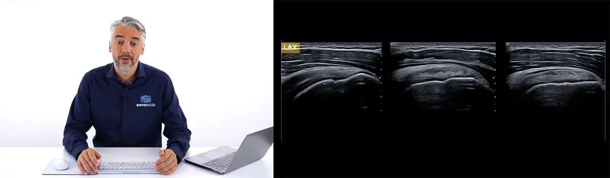 Diagnostic and Interventional MSK Ultrasound Of Subacromial Pain Syndrome