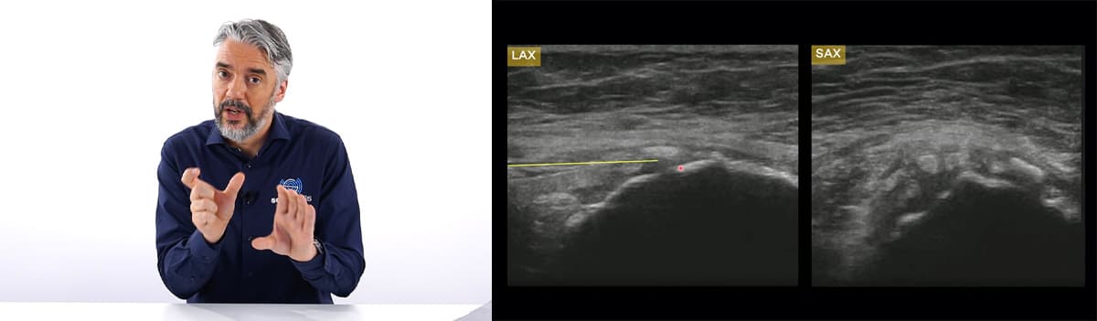 Trochantor Pain in MSK Ultrasound: Performing Diagnostic And Interventional Patient Care