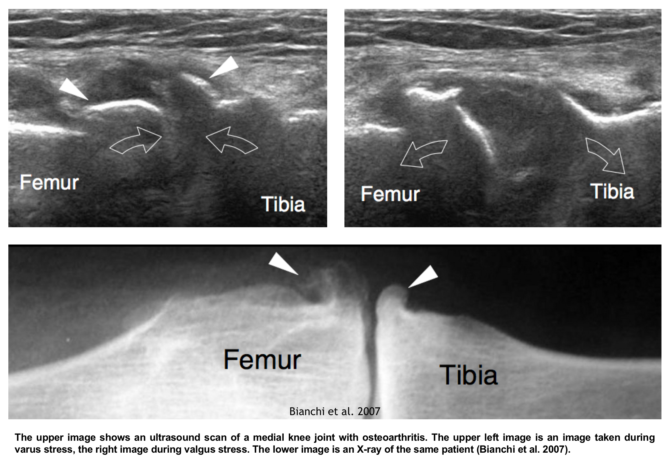 Ultrasound In Knee Osteoarthritis The Added Value Sonoskills