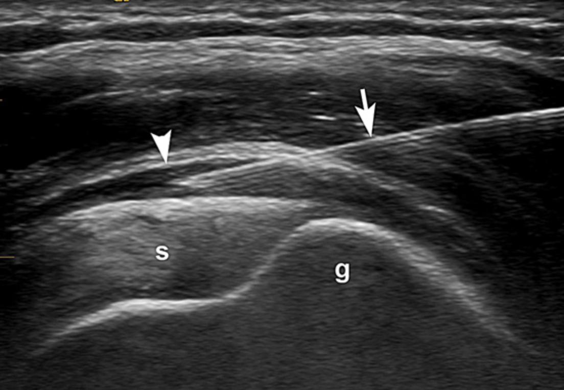 Hip Bursitis Ultrasound