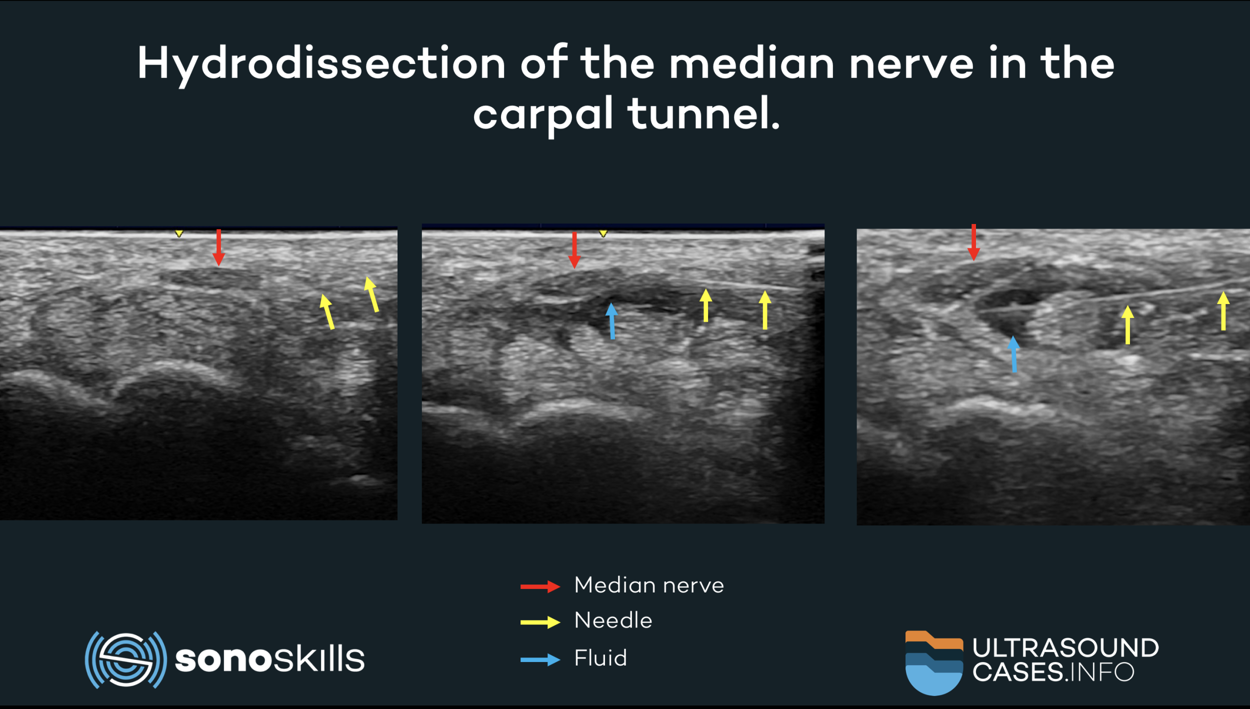 Ultrasound Guided Carpal Tunnel Injection Ulnar Appro - vrogue.co